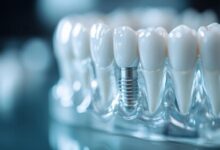 Dental Implants