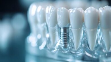 Dental Implants