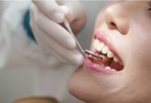 dental implants Brisbane